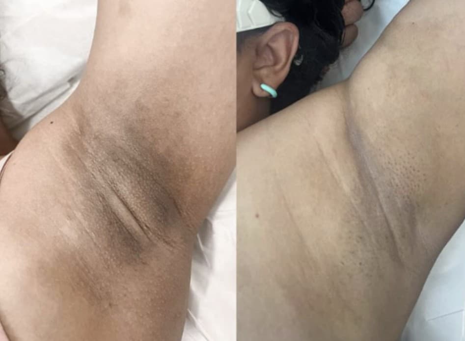 Resultado depilação a laser — caso 1