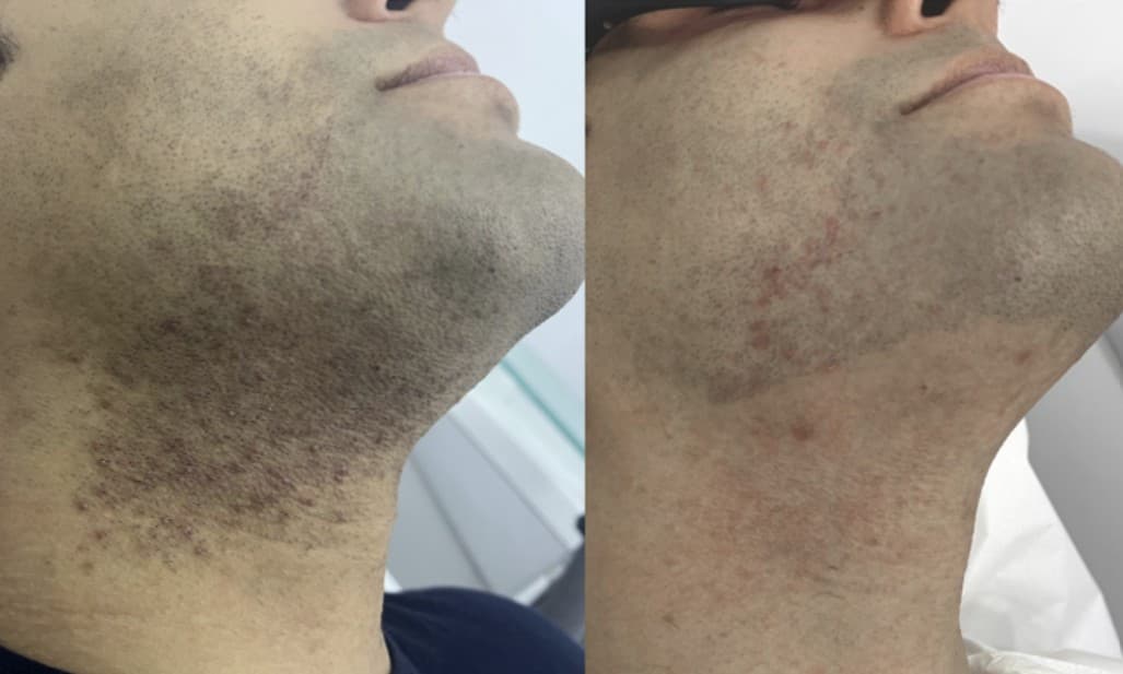 Resultado depilação a laser — caso 2