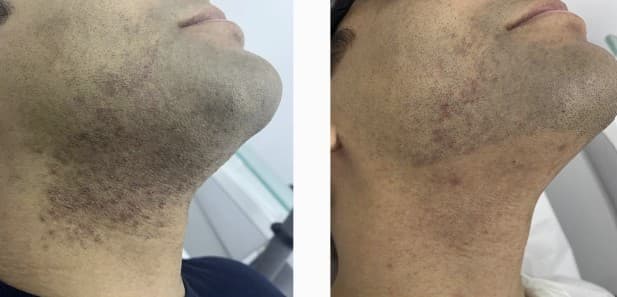 Resultado depilação a laser masculina — caso 1