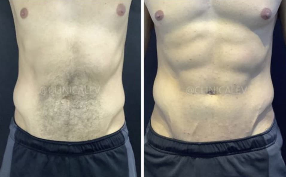 Resultado depilação a laser masculina — caso 2