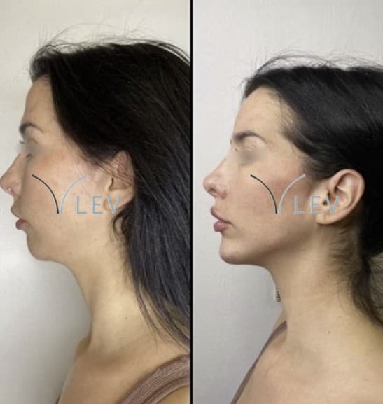 Harmonização Facial