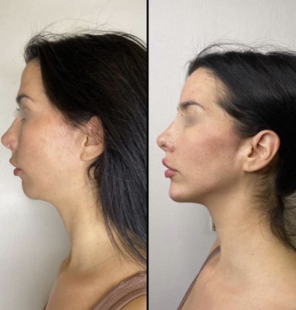 Antes e depois - Toxina botulínica