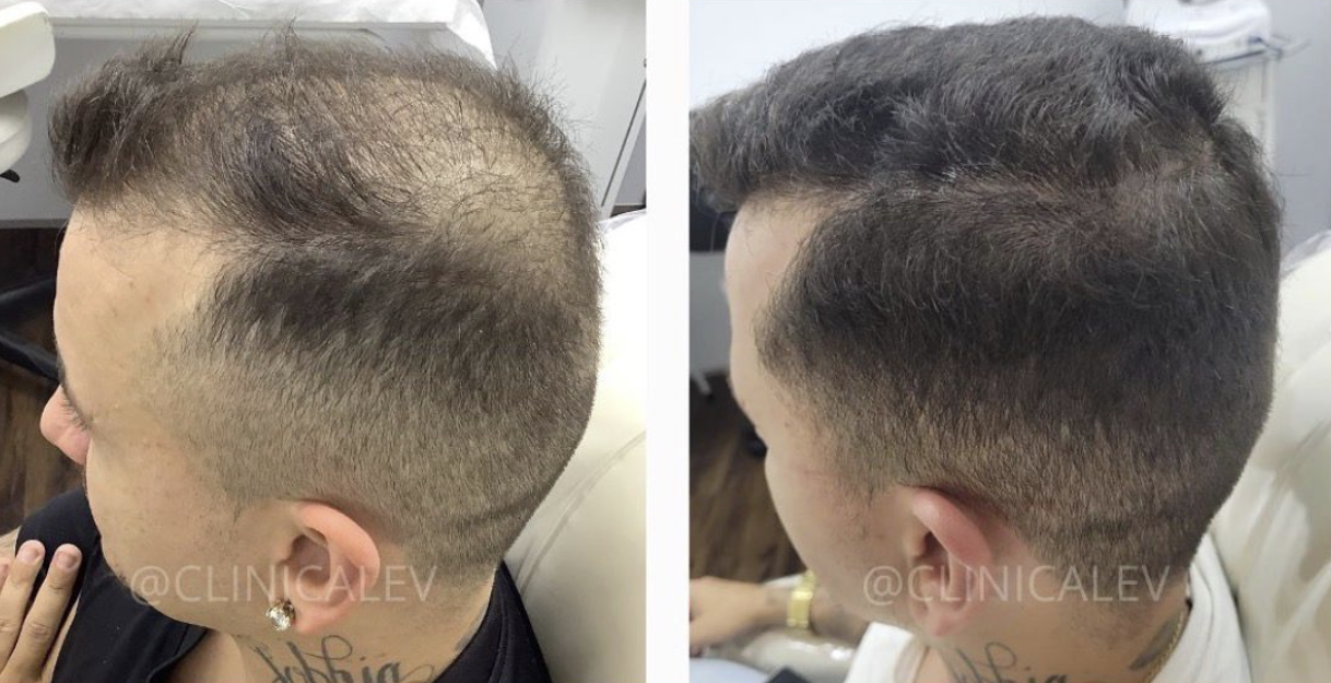 Antes e depois - Tratamento capilar