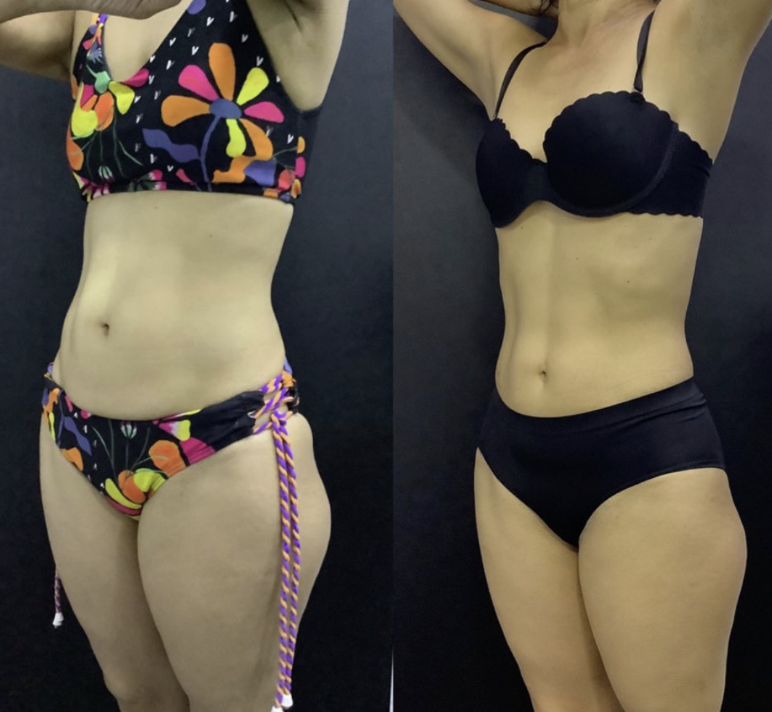 Antes e depois - Tratamento corporal