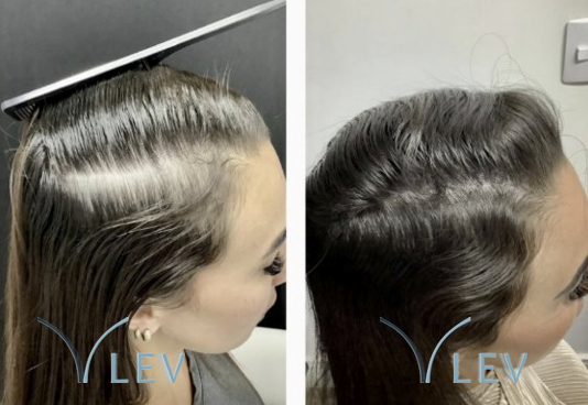 Antes e depois - Preenchimento da linha de divisão feminina