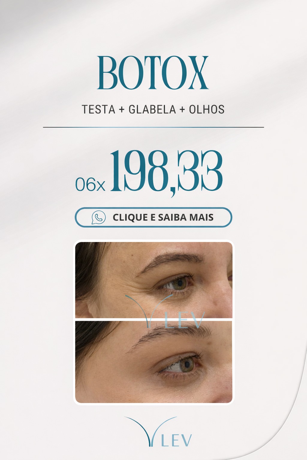 Clínica Lev - Botox